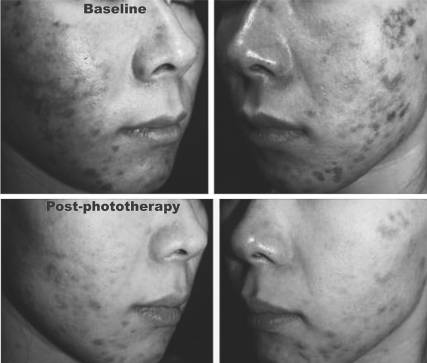 Светодиодная терапия, или «молодильные яблоки» XXI века - 3 Светодиодная терапия, или «молодильные яблоки» XXI века - 3