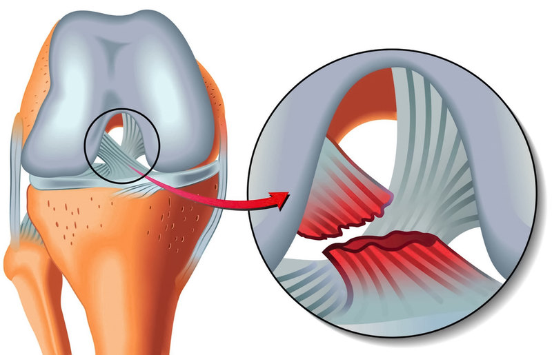 Как ремонтируют порванные связки