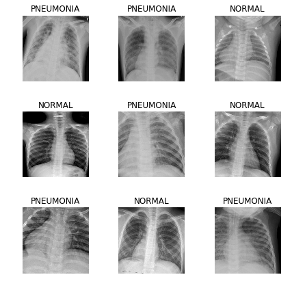 Ищем пневмонию на рентгеновских снимках с Fast.ai - 1