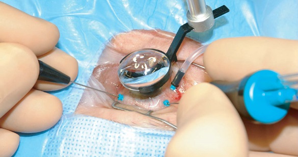 Витрэктомия – бороздим просторы мира, ограниченного полостью глаза - 11 Витрэктомия – бороздим просторы мира, ограниченного полостью глаза - 11