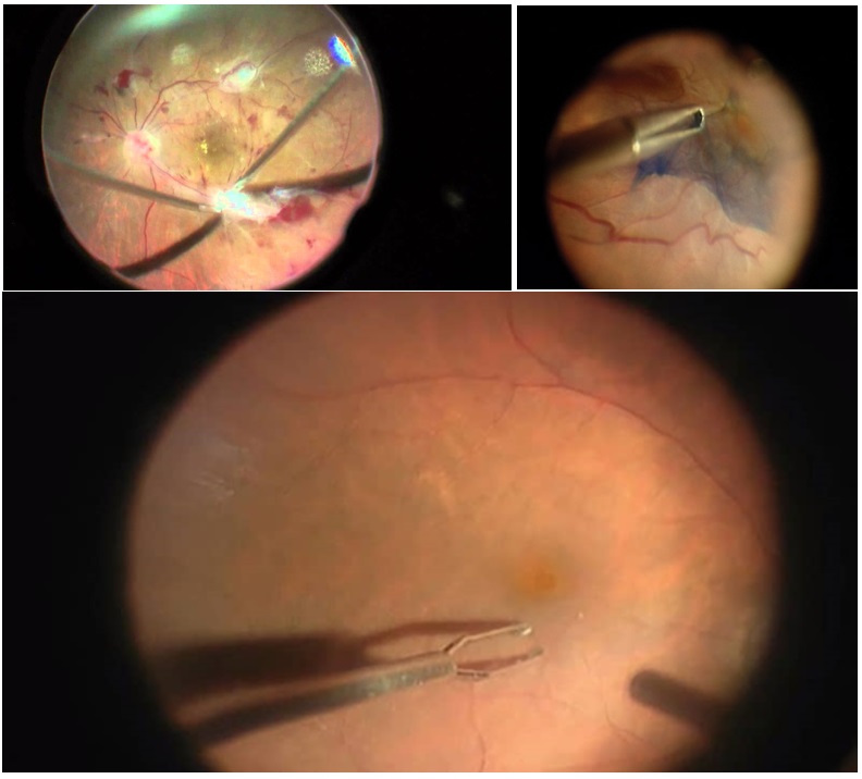 Витрэктомия – бороздим просторы мира, ограниченного полостью глаза - 13 Удаление эпиретинальной мембраны
