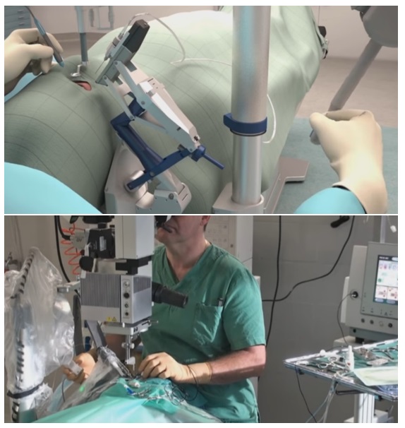 Витрэктомия – бороздим просторы мира, ограниченного полостью глаза - 21 Роботы в офтальмологии