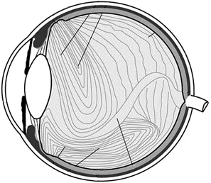 Витрэктомия – бороздим просторы мира, ограниченного полостью глаза - 3 Стекловидное тело глаза