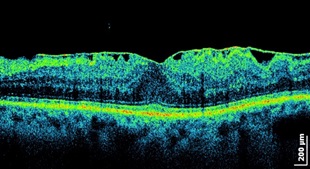 Витрэктомия – бороздим просторы мира, ограниченного полостью глаза - 6 Эпиретинальный фиброз сетчатки