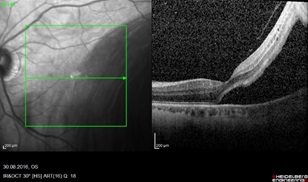 Витрэктомия – бороздим просторы мира, ограниченного полостью глаза - 7 Отслоение сетчатки глаза