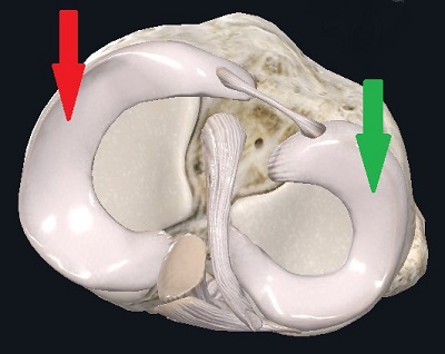 Мениски в коленном суставе — что это, зачем это, как это лечится если повредилось? - 2