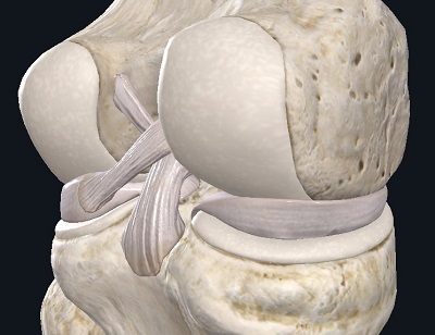 Мениски в коленном суставе — что это, зачем это, как это лечится если повредилось? - 4