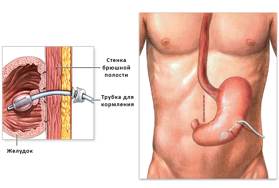 Операция зонд. Чрескожная гастростома эндоскопическая. Строение трубки гастростомы. Гастростома для энтерального питания. Трубчатая гастростома.