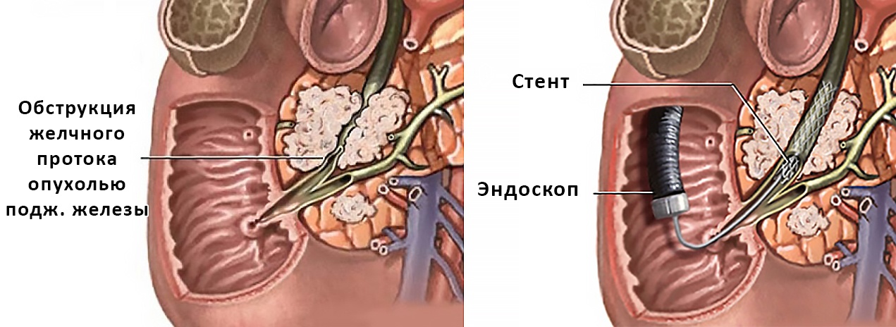 Делают ли операцию на поджелудочную. Эндоскопическое стентирование холедоха. Эндоскопическое стентирование желчного протока. Эндоскопическое стентирование панкреатического протока. Стентирование холедоха желчного протока.
