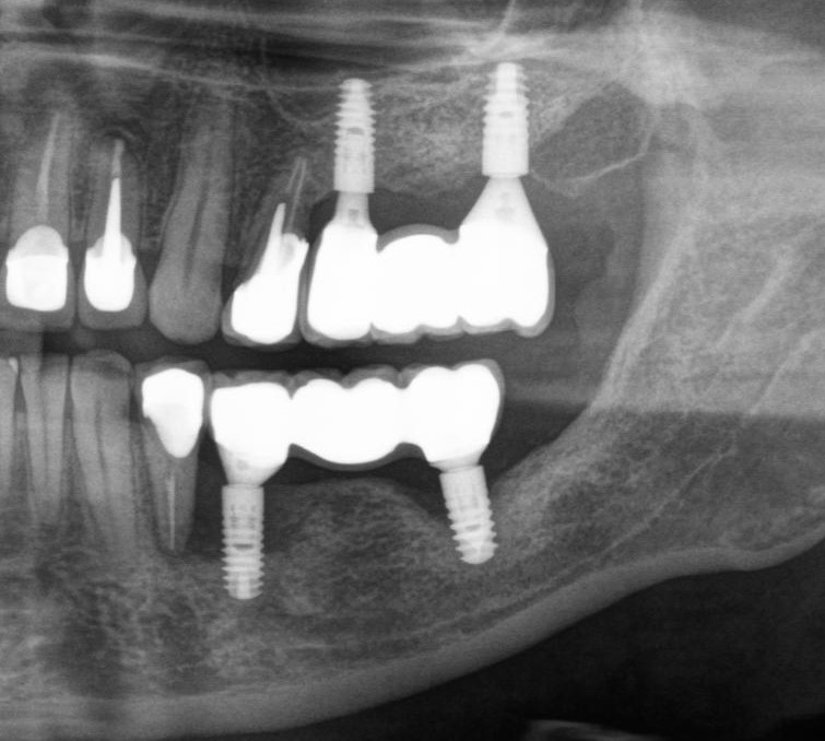 Можно ли с зубным имплантом делать мрт. Неудачная имплантация зубов. Импланты зубов в реальности.
