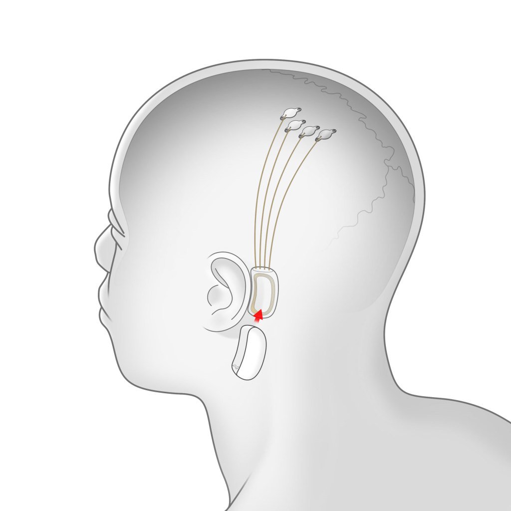 Слияние человека и машины. Neuralink - 6