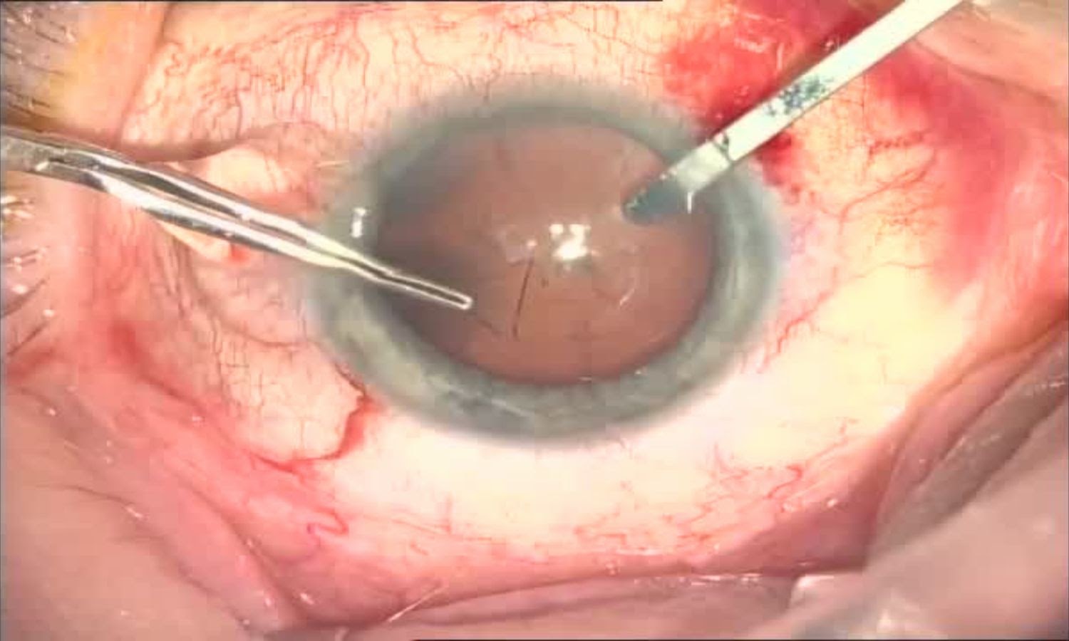 Операция «Глаз»: руки, линза и алмаз. Контрнаступление на катаракту - 12