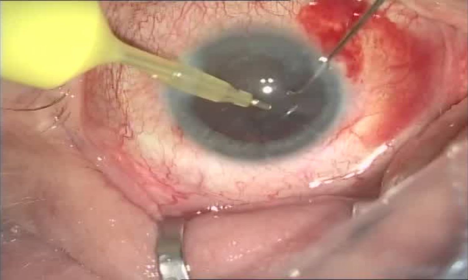 Операция «Глаз»: руки, линза и алмаз. Контрнаступление на катаракту - 16