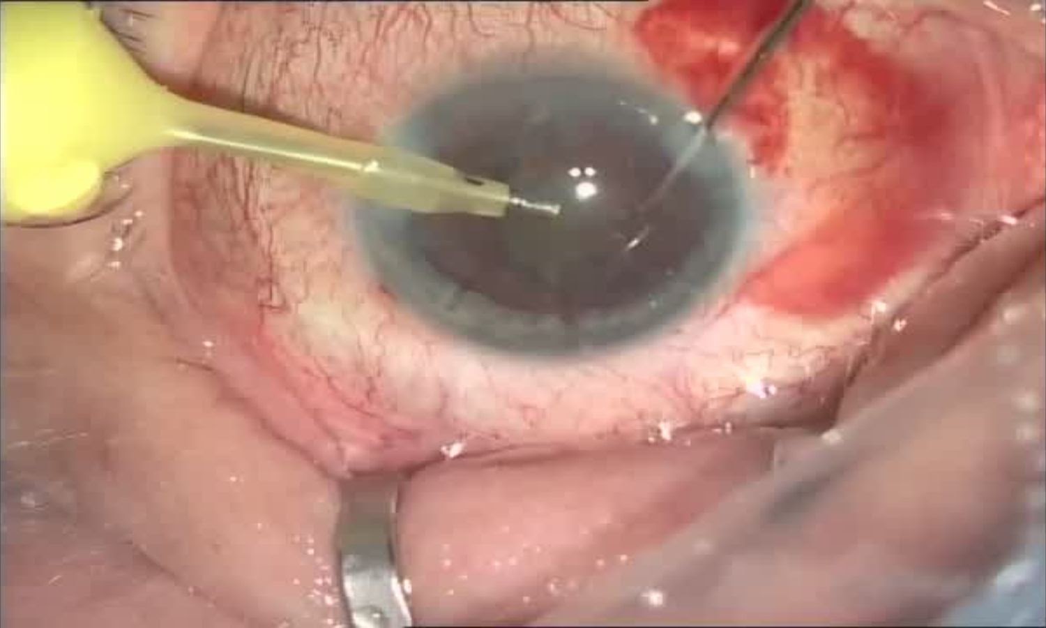 Операция «Глаз»: руки, линза и алмаз. Контрнаступление на катаракту - 17