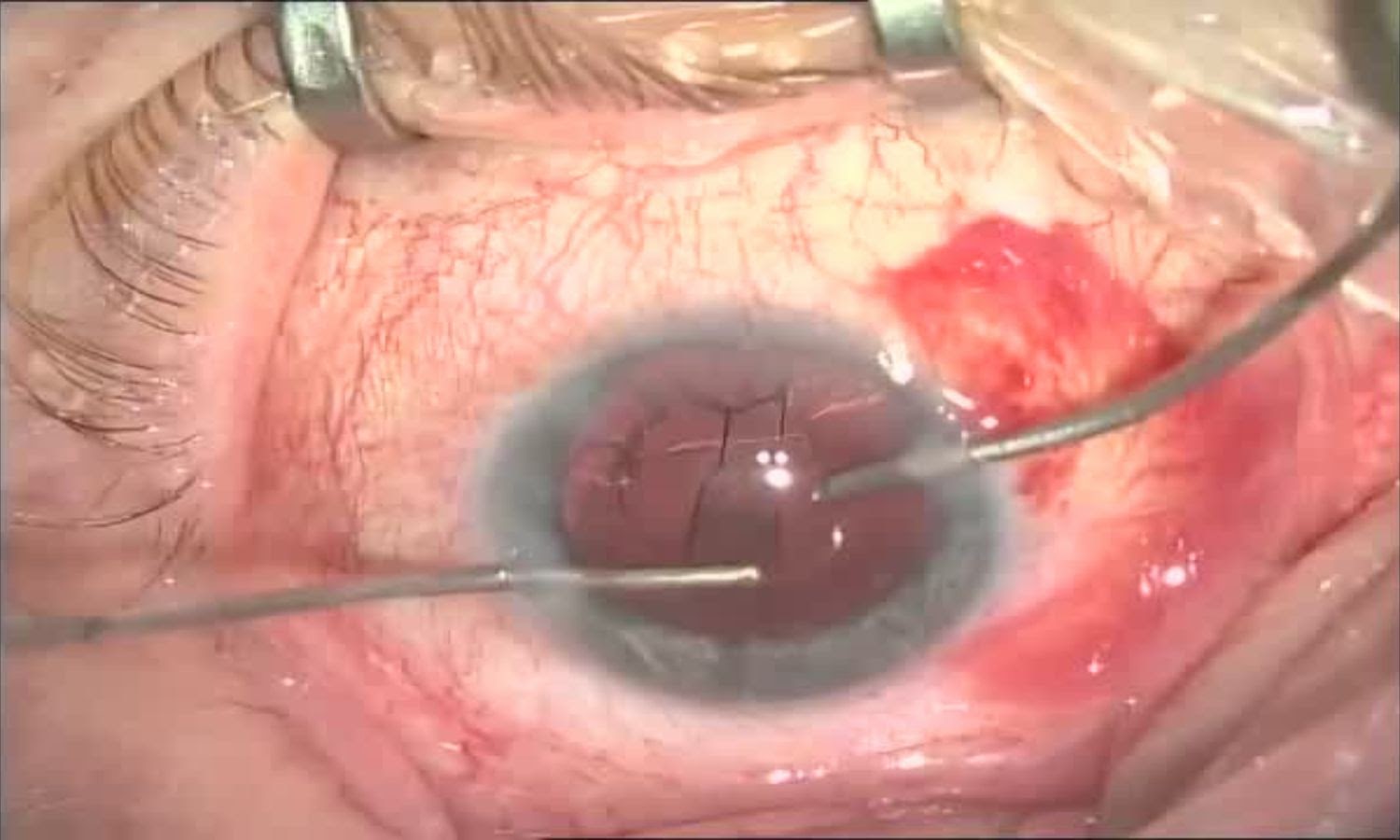 Операция «Глаз»: руки, линза и алмаз. Контрнаступление на катаракту - 18