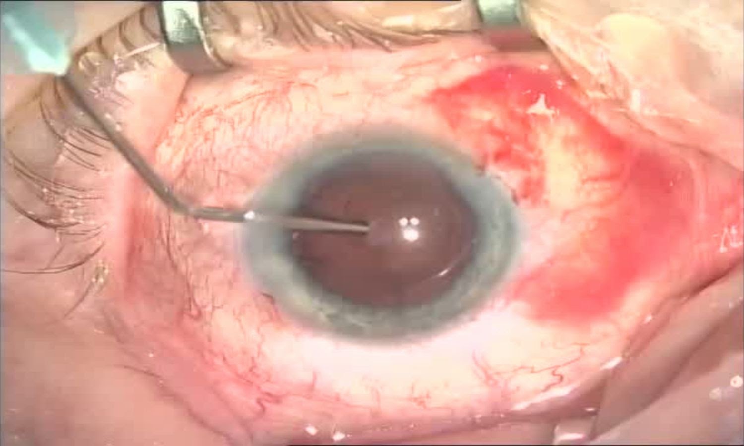 Операция «Глаз»: руки, линза и алмаз. Контрнаступление на катаракту - 21