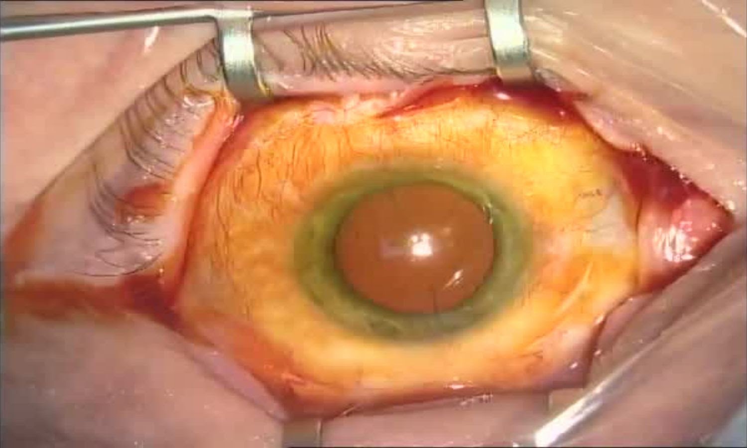 Операция «Глаз»: руки, линза и алмаз. Контрнаступление на катаракту - 6
