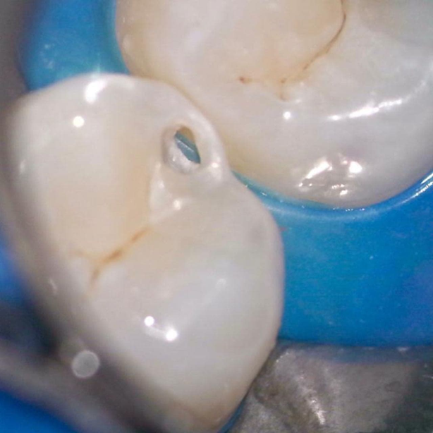 Кариес и как он работает - 13 image