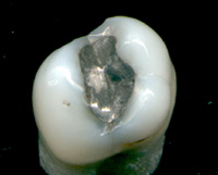 Кариес и как он работает - 15 image