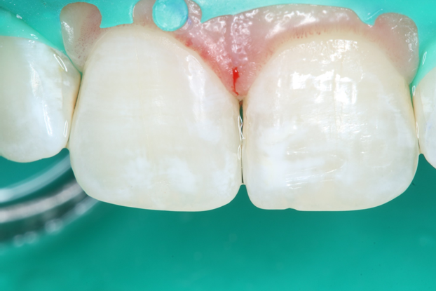 Кариес и как он работает - 6 image