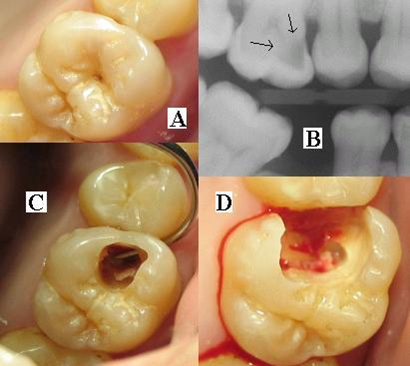 Кариес и как он работает - 7 image