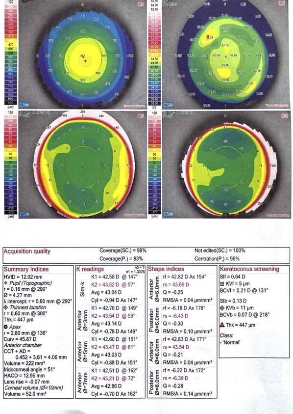 Опыт коррекции зрения под общим наркозом по методике ReLEx Smile или Как лишиться нормального зрения на один глаз - 11 Опыт коррекции зрения под общим наркозом по методике ReLEx Smile или Как лишиться нормального зрения на один глаз - 11