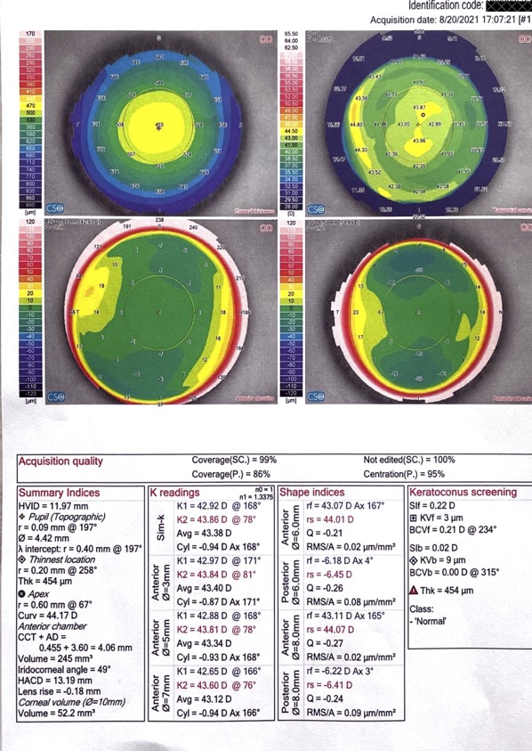 Опыт коррекции зрения под общим наркозом по методике ReLEx Smile или Как лишиться нормального зрения на один глаз - 12 Опыт коррекции зрения под общим наркозом по методике ReLEx Smile или Как лишиться нормального зрения на один глаз - 12