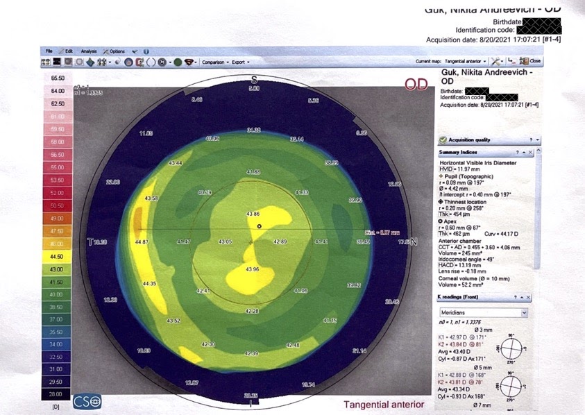 Опыт коррекции зрения под общим наркозом по методике ReLEx Smile или Как лишиться нормального зрения на один глаз - 13 Опыт коррекции зрения под общим наркозом по методике ReLEx Smile или Как лишиться нормального зрения на один глаз - 13