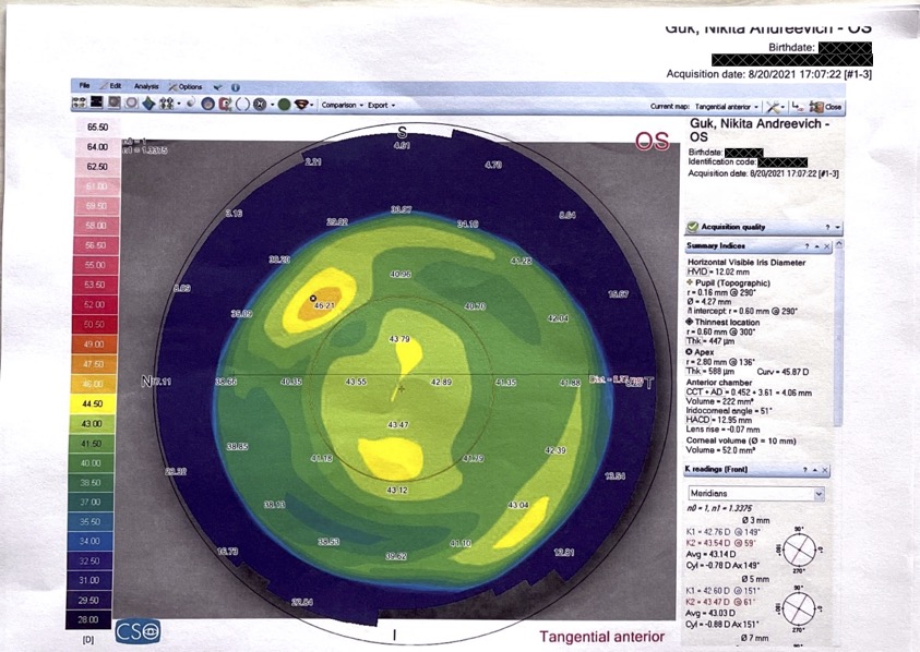 Опыт коррекции зрения под общим наркозом по методике ReLEx Smile или Как лишиться нормального зрения на один глаз - 14 Опыт коррекции зрения под общим наркозом по методике ReLEx Smile или Как лишиться нормального зрения на один глаз - 14
