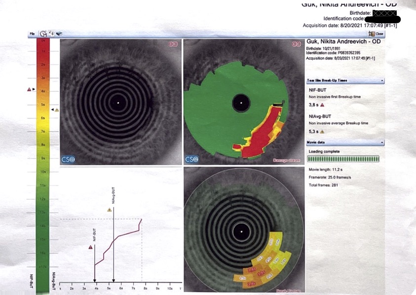Опыт коррекции зрения под общим наркозом по методике ReLEx Smile или Как лишиться нормального зрения на один глаз - 15 Опыт коррекции зрения под общим наркозом по методике ReLEx Smile или Как лишиться нормального зрения на один глаз - 15