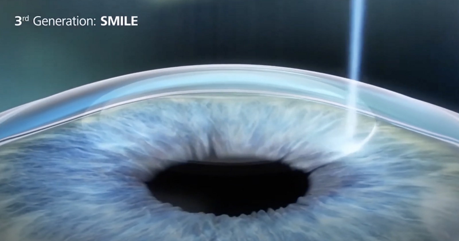 Опыт коррекции зрения под общим наркозом по методике ReLEx Smile или Как лишиться нормального зрения на один глаз - 1