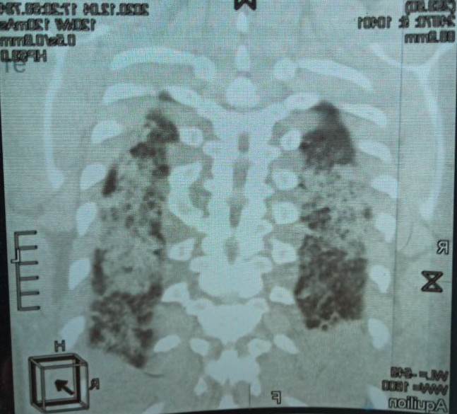 На картинке изображена КТ моих легких на момент поступления в больницу.