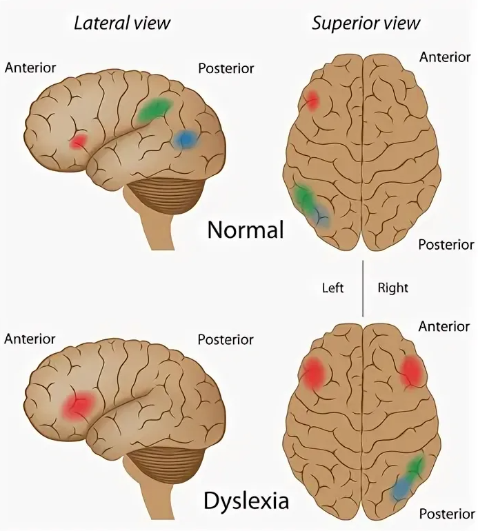 На картинке изображён боковой разрез и вид сверху мозга человека с нормой и человека с дислексией. Если говорить обывательским языком, красные точки — зона, ответственная за артикуляцию и анализ слов своей речи (зона Брока), синие и зелёные — анализ речи и восприятие словоформ как цельных единиц. Зелёные и синие вместе — теменно-височно-затылочная область, которая в случае нормы активна в левом полушарии