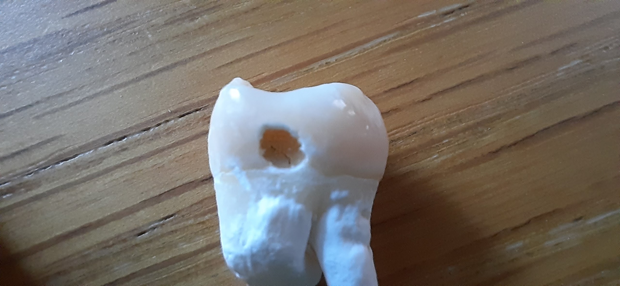 Дырка в зубе после чистки и вымачивания в белизне. Запах ушел.