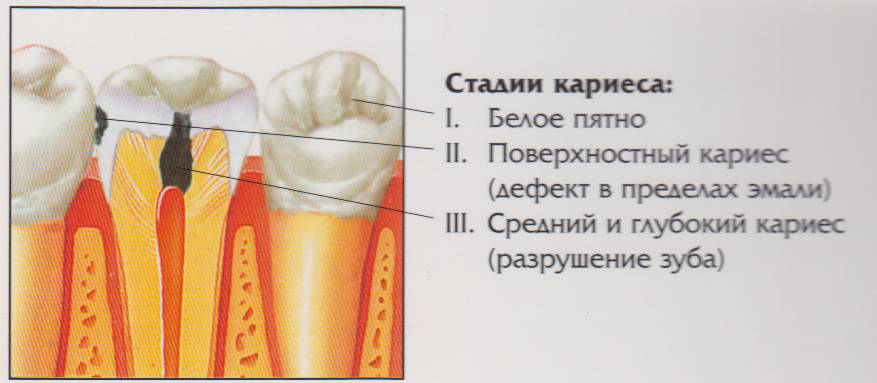 Флюороз — противоположность кариеса (и проверьте, что за воду вы пьёте) - 15