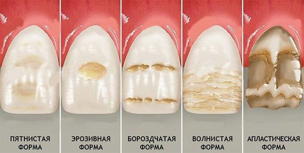 Флюороз — противоположность кариеса (и проверьте, что за воду вы пьёте) - 8