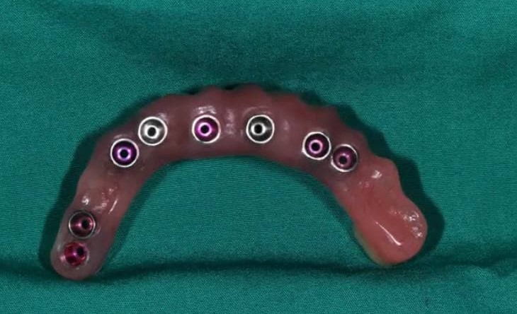 Пациент, который упал с третьего этажа на зубы и попал в учебные материалы - 16