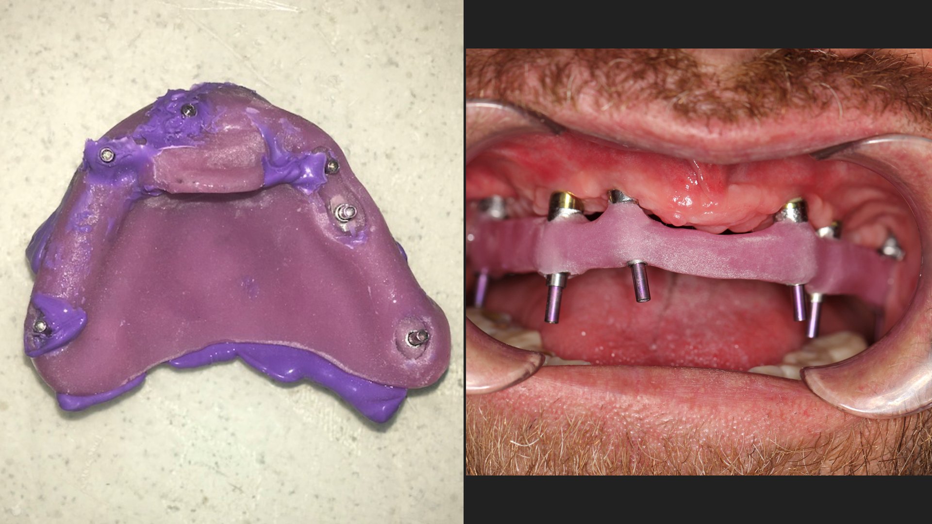 Пациент, который упал с третьего этажа на зубы и попал в учебные материалы - 20