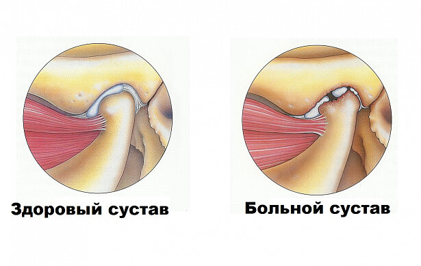 Щелчки в суставе - 4