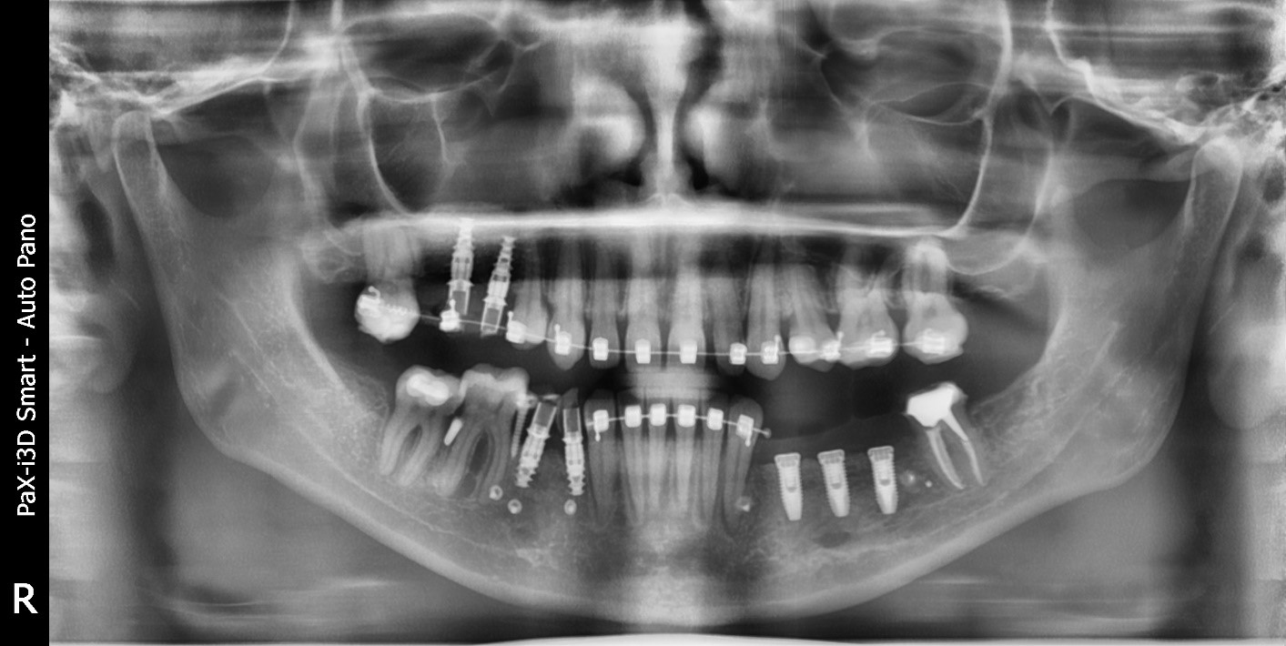 Случай девушки без трёх зубов: как наращивается кость перед установкой импланта; зачем и как организм меняет скелет - 10