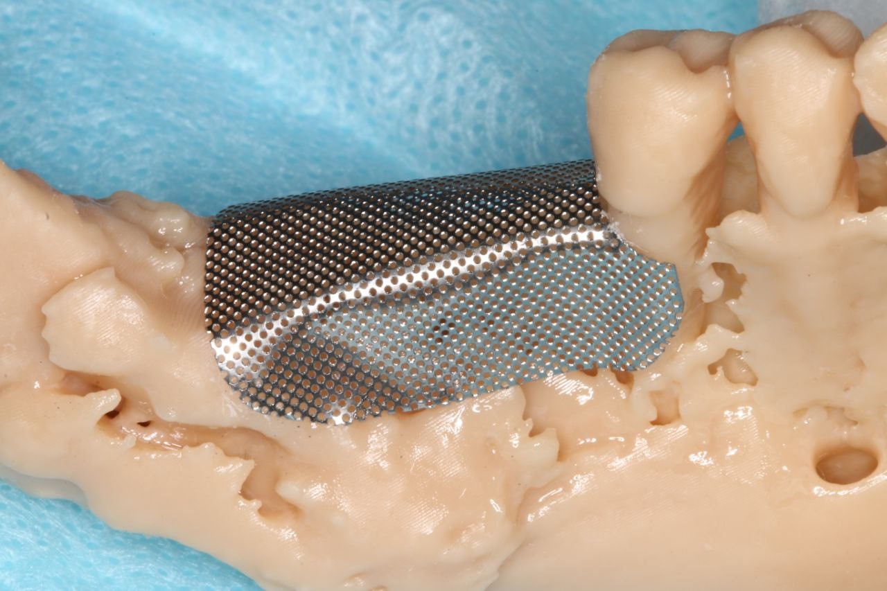 Случай девушки без трёх зубов: как наращивается кость перед установкой импланта; зачем и как организм меняет скелет - 11