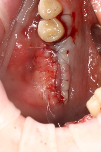 Случай девушки без трёх зубов: как наращивается кость перед установкой импланта; зачем и как организм меняет скелет - 13