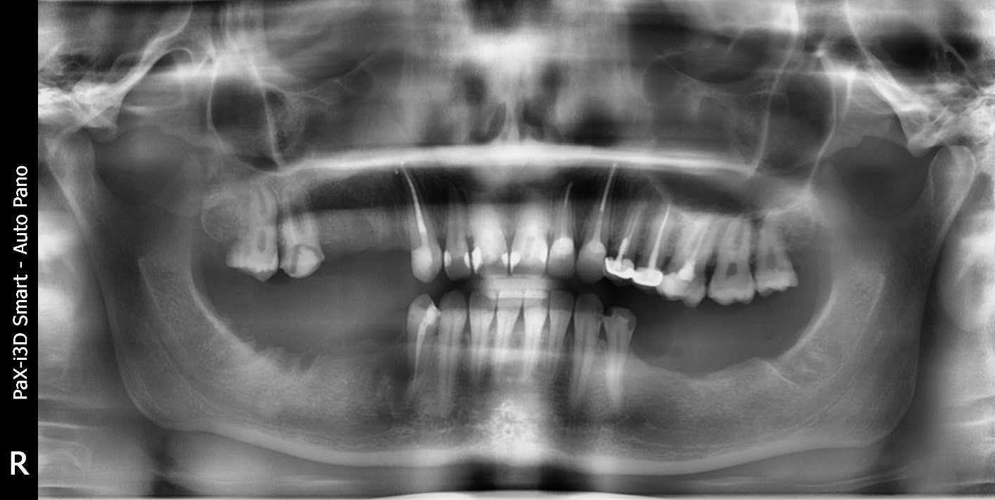Случай девушки без трёх зубов: как наращивается кость перед установкой импланта; зачем и как организм меняет скелет - 2
