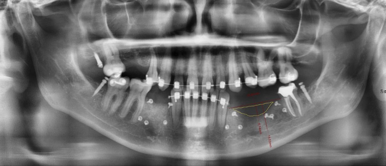 Случай девушки без трёх зубов: как наращивается кость перед установкой импланта; зачем и как организм меняет скелет - 4