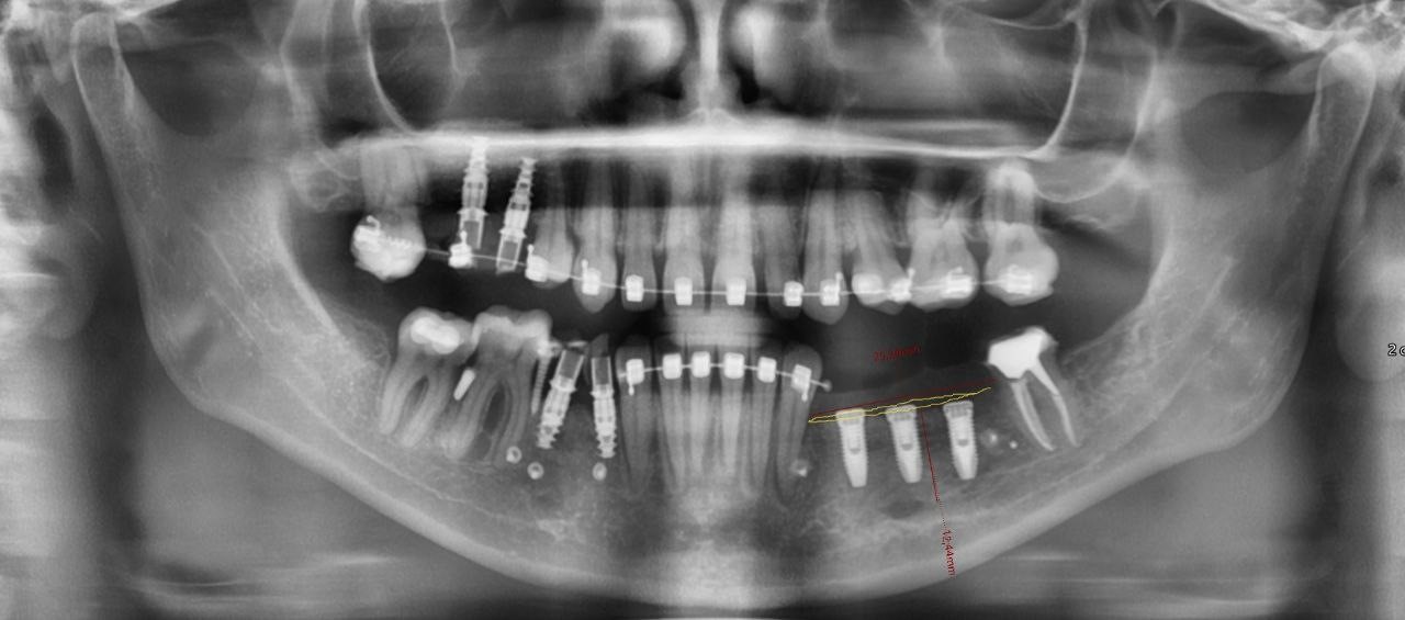 Случай девушки без трёх зубов: как наращивается кость перед установкой импланта; зачем и как организм меняет скелет - 5