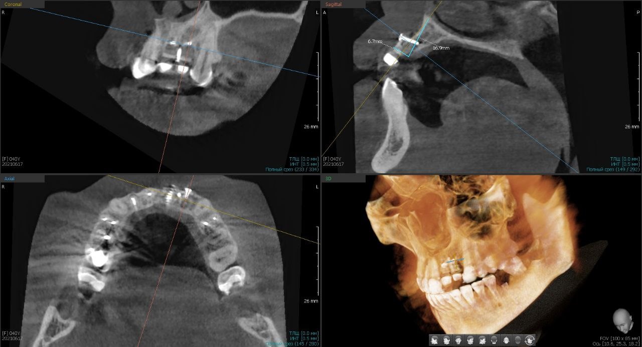 Случай девушки без трёх зубов: как наращивается кость перед установкой импланта; зачем и как организм меняет скелет - 6