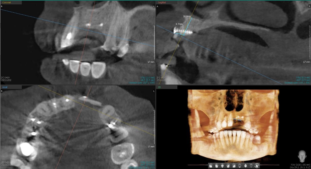 Случай девушки без трёх зубов: как наращивается кость перед установкой импланта; зачем и как организм меняет скелет - 7