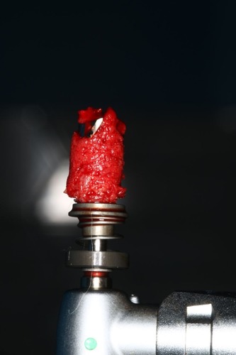 Случай девушки без трёх зубов: как наращивается кость перед установкой импланта; зачем и как организм меняет скелет - 8 Случай девушки без трёх зубов: как наращивается кость перед установкой импланта; зачем и как организм меняет скелет - 8