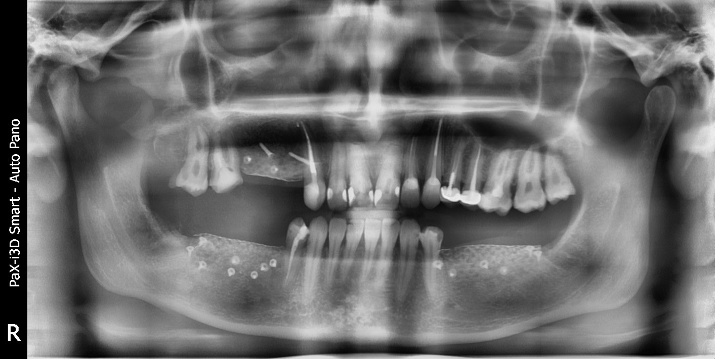 Случай девушки без трёх зубов: как наращивается кость перед установкой импланта; зачем и как организм меняет скелет - 9 Случай девушки без трёх зубов: как наращивается кость перед установкой импланта; зачем и как организм меняет скелет - 9