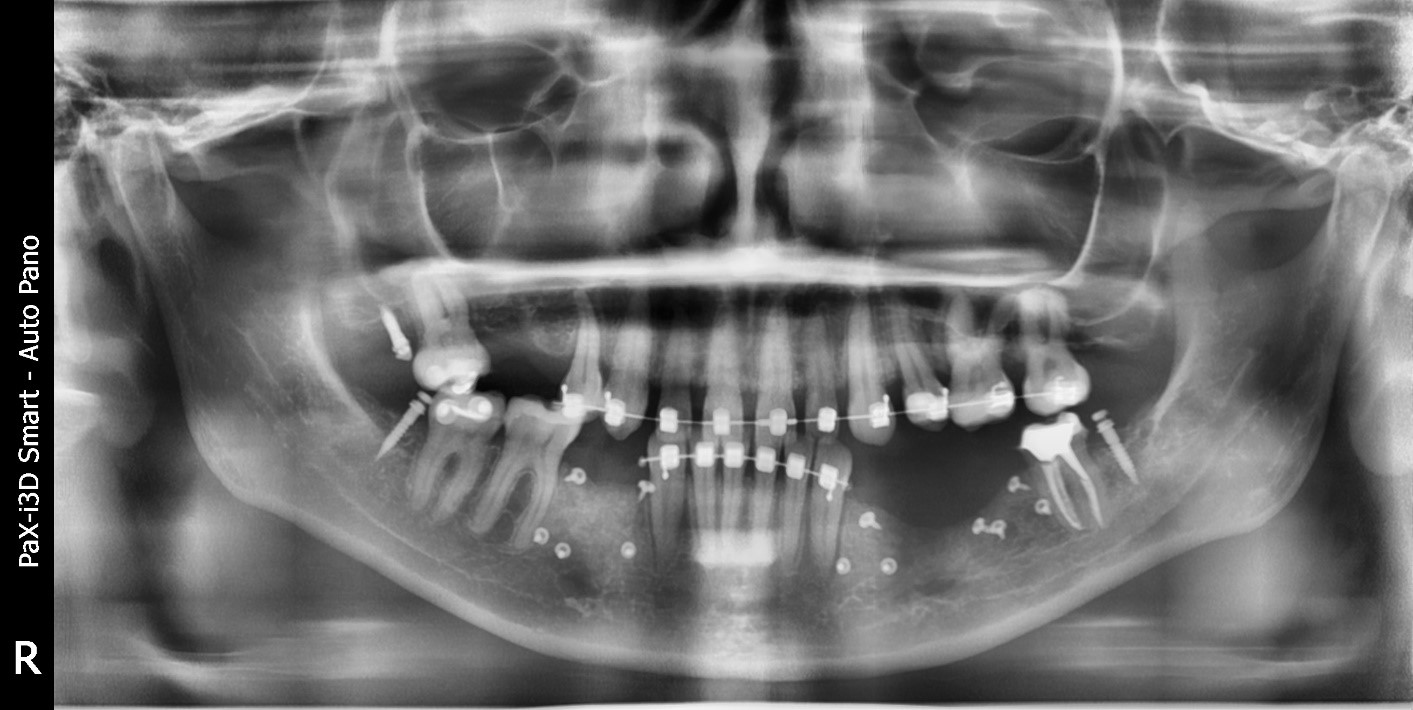 Случай девушки без трёх зубов: как наращивается кость перед установкой импланта; зачем и как организм меняет скелет - 1